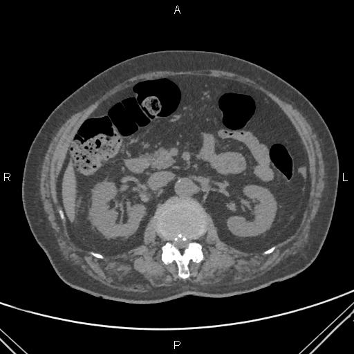 File:Acute renal artery occlusion (Radiopaedia 86586-102682 Axial non-contrast 30).jpg