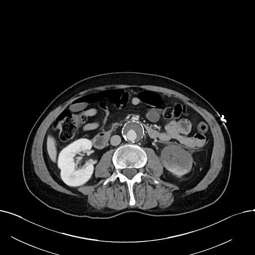 Acute renal infarction (Radiopaedia 59375-66736 Axial C+ portal venous phase 49).jpg