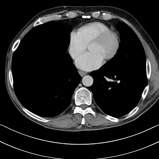 Acute renal infarction - rim capsular enhancement (Radiopaedia 59833-67270 Axial C+ portal venous phase 2).jpg