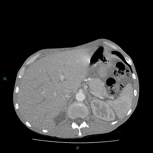 File:Acute right lung abscess (Radiopaedia 34806-36258 Axial C+ arterial phase 184).jpg