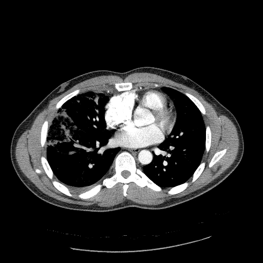 Acute segmental pulmonary emboli and pulmonary infarction (Radiopaedia 62264-70444 Axial C+ CTPA 68).jpg
