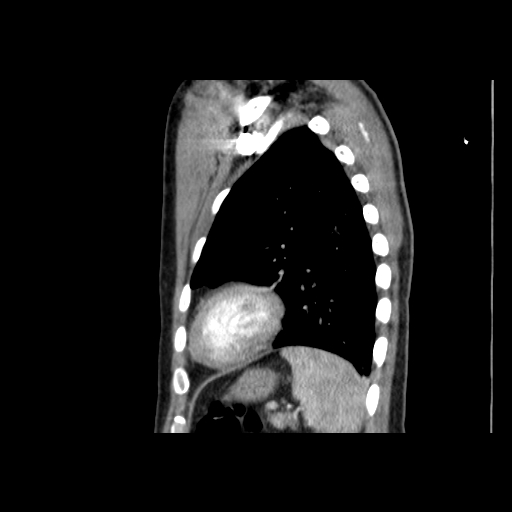 File:Acute segmental pulmonary emboli and pulmonary infarction (Radiopaedia 62264-70444 Sagittal C+ CTPA 51).jpg