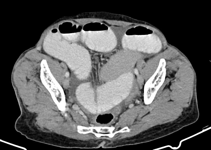 Acute small bowel (ileal) volvulus (Radiopaedia 71740-82139 Axial C+ portal venous phase 163).jpg
