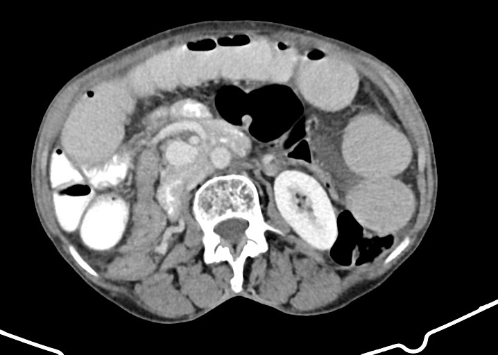 Acute small bowel (ileal) volvulus (Radiopaedia 71740-82139 Axial C+ portal venous phase 94).jpg
