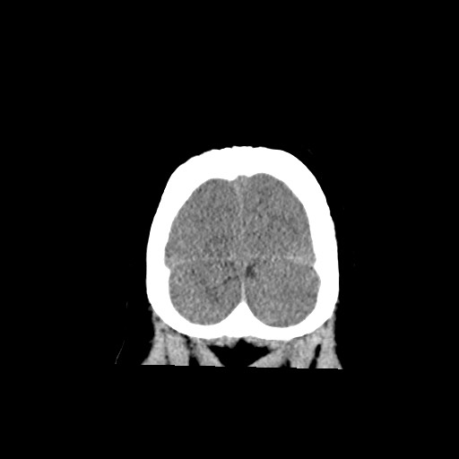 Acute subarachnoid hemorrhage and accessory anterior cerebral artery (Radiopaedia 69231-79008 Coronal non-contrast 64).jpg