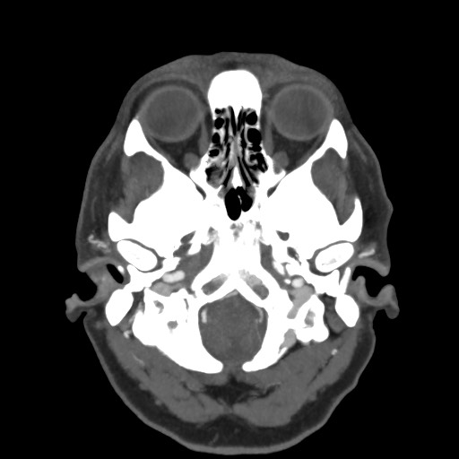 Acute subarachnoid hemorrhage and accessory anterior cerebral artery (Radiopaedia 69231-79009 D 12).jpg