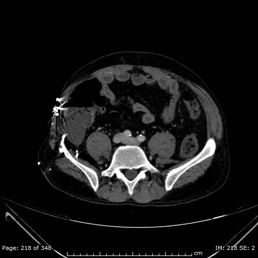 Acute superior mesenteric artery occlusion (Radiopaedia 43636-47060 Axial C+ portal venous phase 38).jpg