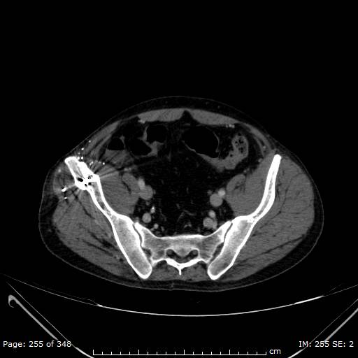 Acute superior mesenteric artery occlusion (Radiopaedia 43636-47060 Axial C+ portal venous phase 49).jpg