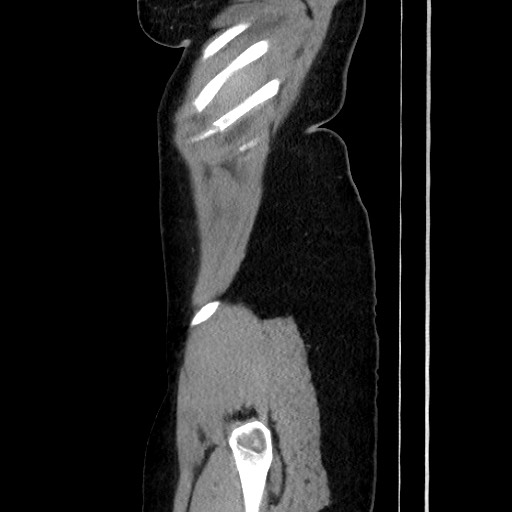 Acute uncomplicated appendicitis (Radiopaedia 73704-84499 Sagittal C+ portal venous phase 48).jpg