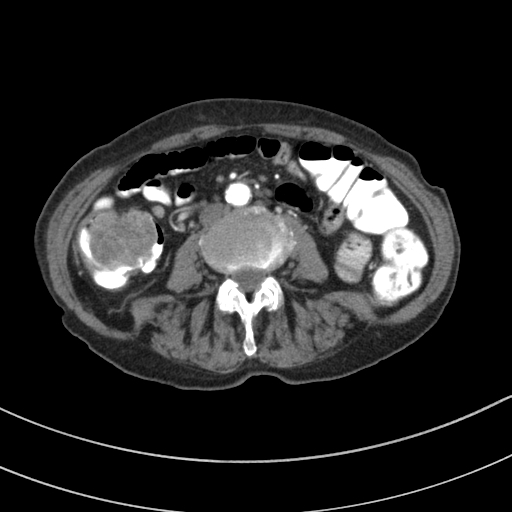 Adenocarcinoma of cecum (Radiopaedia 59222-66549 Axial C+ arterial phase 82).jpg