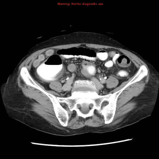 Adenocarcinoma of the colon (Radiopaedia 8191-9039 Axial renal excretory phase 39).jpg