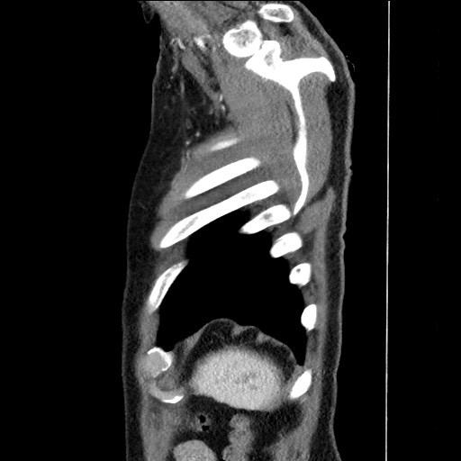 Adenocarcinoma of the lung (Radiopaedia 59871-67325 Sagittal C+ arterial phase 95).jpg