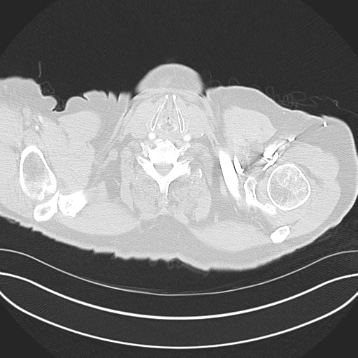 Adenocarcioma of rectum- T1 lesion (Radiopaedia 36921-38547 Axial lung window 1).png
