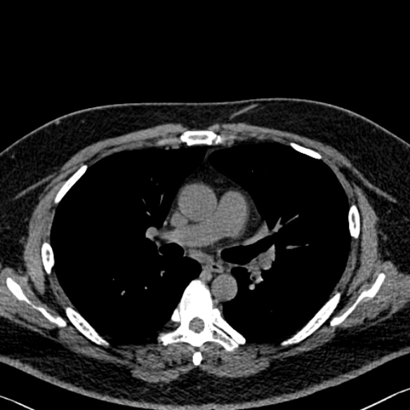 Adenoid cystic carcinoma of the trachea (Radiopaedia 49042-54137 Axial non-contrast 153).jpg