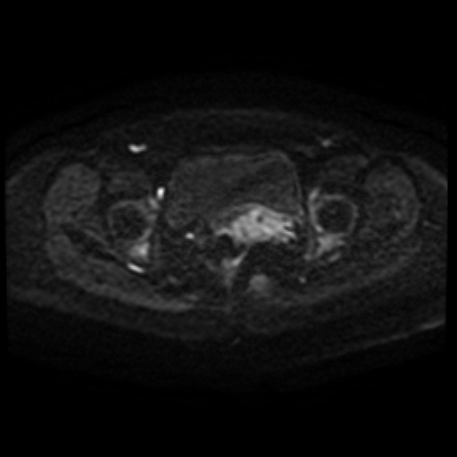 File:Adenoma malignum of cervix (Radiopaedia 66441-75705 Axial DWI 91).jpg