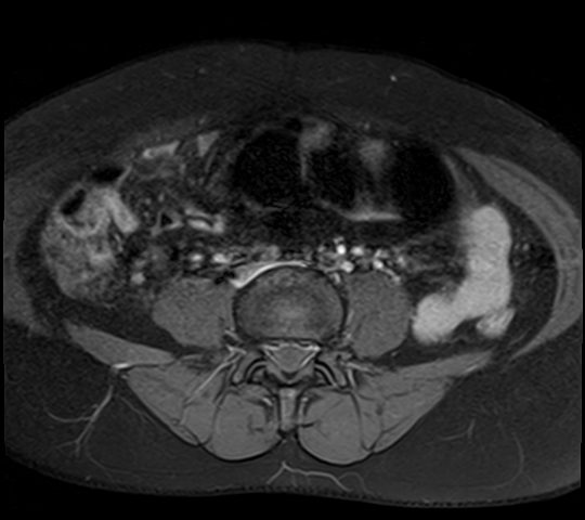 File:Adenomyosis - ovarian endometriomas (Radiopaedia 67031-76350 Axial T1 C+ fat sat 2).jpg