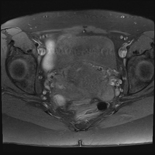 File:Adenomyosis and endometriotic cysts (Radiopaedia 82300-96367 Axial T1 fat sat 9).jpg