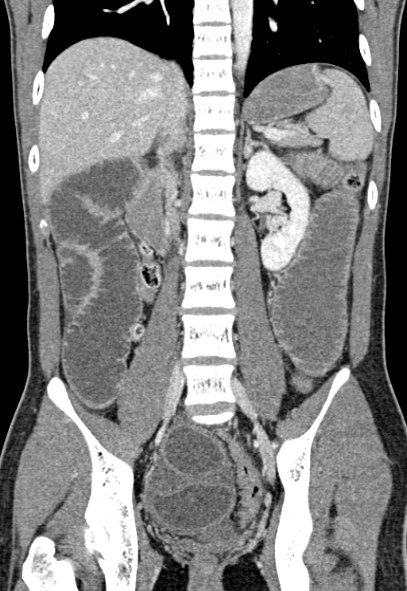 File:Adhesional small bowel obstruction (Radiopaedia 52107-57980 Coronal C+ portal venous phase 50).jpg