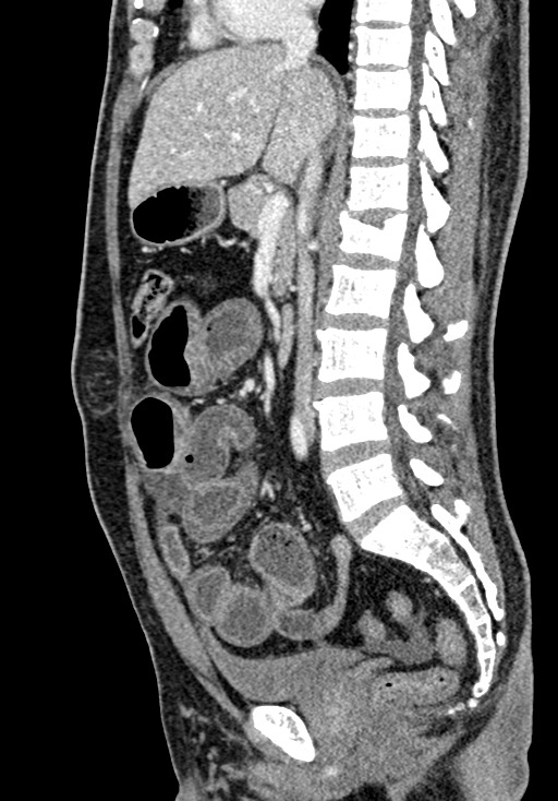 Adhesional small bowel obstruction (Radiopaedia 58900-66131 Sagittal C+ portal venous phase 119).jpg