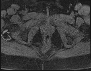File:Adnexal multilocular cyst (O-RADS US 3. O-RADS MRI 3) (Radiopaedia 87426-103754 Axial 214).jpeg