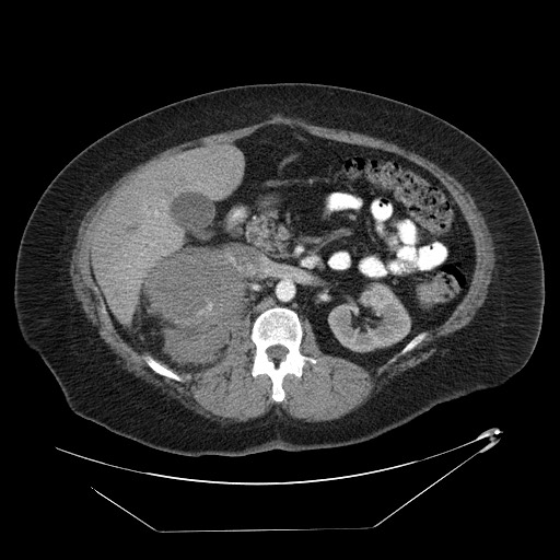 Adrenal angiosarcoma (Radiopaedia 81081-94671 Axial C+ arterial phase 31).jpg