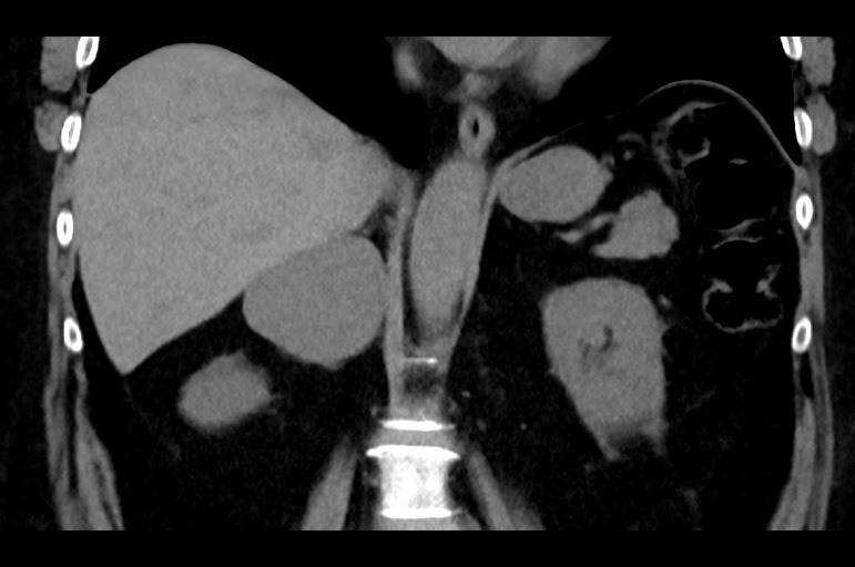 Adrenal cortical carcinoma (Radiopaedia 64017-72769 Coronal non-contrast 34).jpg