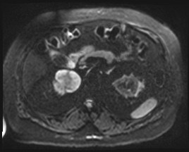 Adrenal cortical carcinoma (Radiopaedia 64017-72770 Axial DWI 61).jpg