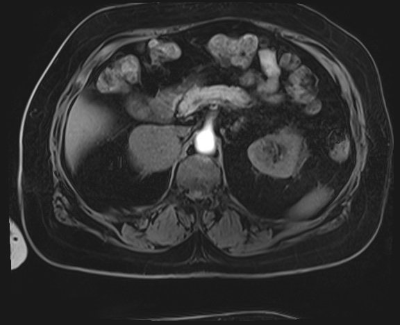 Adrenal cortical carcinoma (Radiopaedia 64017-72770 Axial T1 C+ fat sat 14).jpg