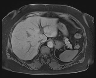Adrenal cortical carcinoma (Radiopaedia 64017-72770 Axial T1 fat sat 15).jpg