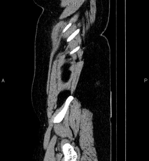 Adrenal cortical carcinoma (Radiopaedia 84882-100379 Sagittal C+ portal venous phase 7).jpg