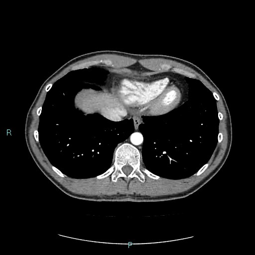 Adrenal cystic lymphangioma (Radiopaedia 83161-97534 Axial C+ arterial phase 11).jpg