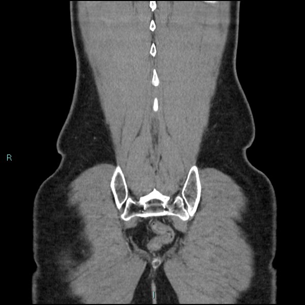 Adrenal cystic lymphangioma (Radiopaedia 83161-97534 Coronal C+ portal venous phase 70).jpg