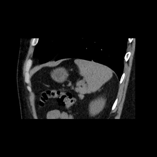 Adrenal gland trauma (Radiopaedia 81351-95079 Sagittal non-contrast 83).jpg