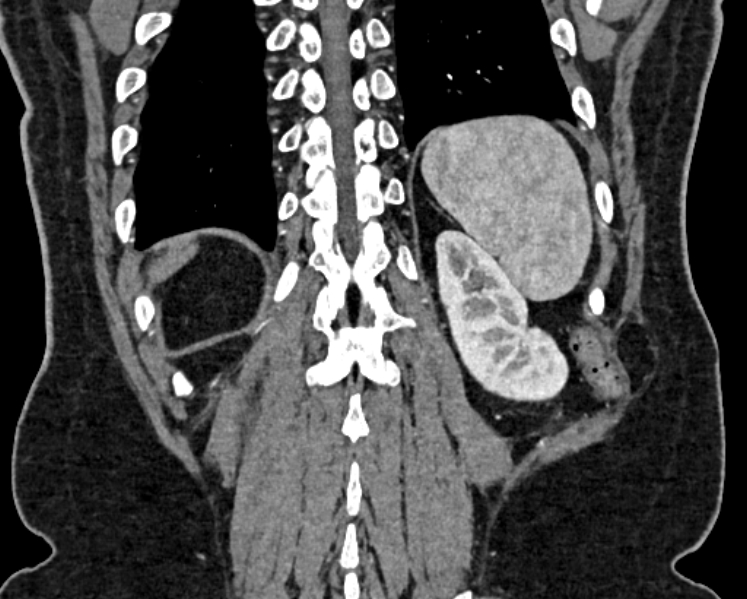 File:Adrenal metastases (Radiopaedia 73082-83791 Coronal C+ arterial phase 72).jpg