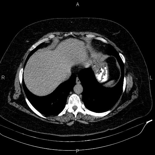 Adrenal myelolipoma (Radiopaedia 84319-99617 Axial With oral contrast 27).jpg