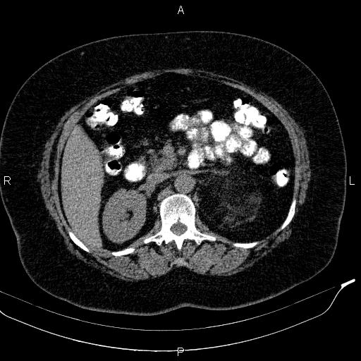 Adrenal myelolipoma (Radiopaedia 84319-99617 Axial With oral contrast 84).jpg