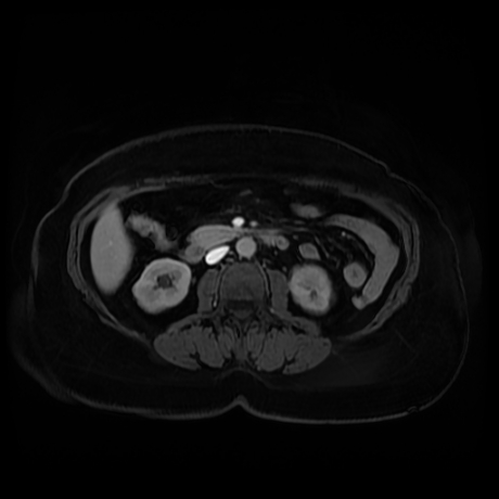 Adrenal myelolipoma - MRI (Radiopaedia 83249-97646 T1 fat sat arterial phase 54).jpg