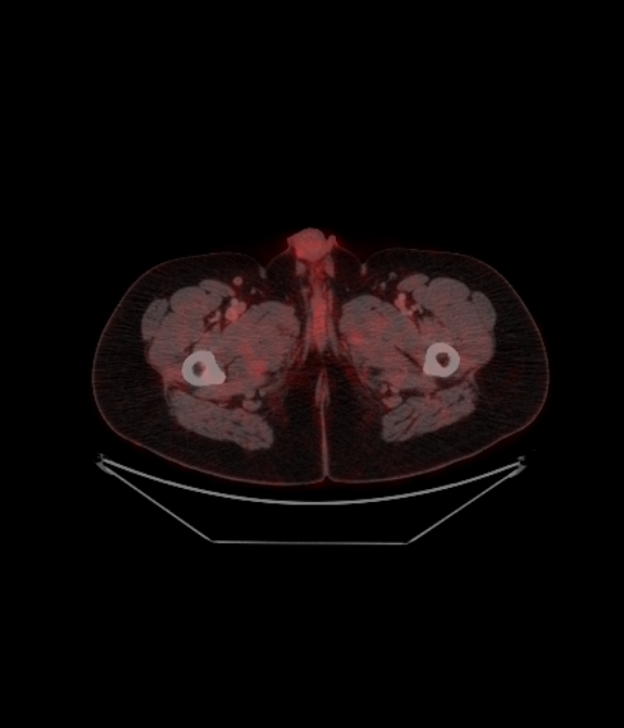Adrenocortical carcinoma (Radiopaedia 80134-93440 ِAxial 269).jpg