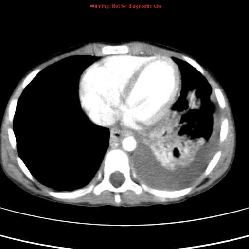 File:Adrenocortical carcinoma (Radiopaedia 9449-10131 Axial C+ portal venous phase 3).jpg