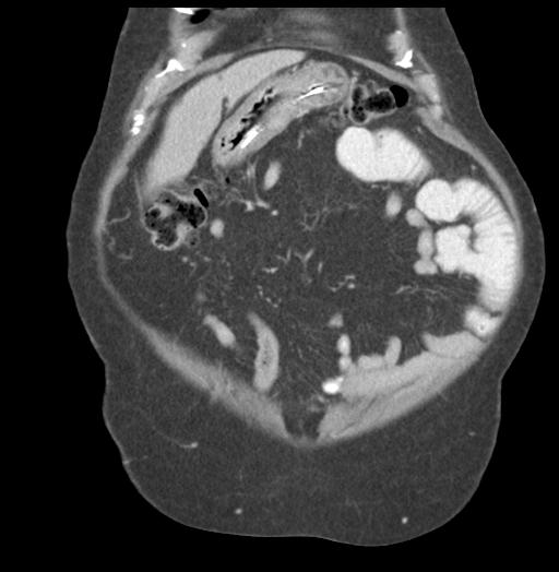 Adult ileal intussusception with secondary obstruction (Radiopaedia 30395-31051 Coronal C+ portal venous phase 15).jpg