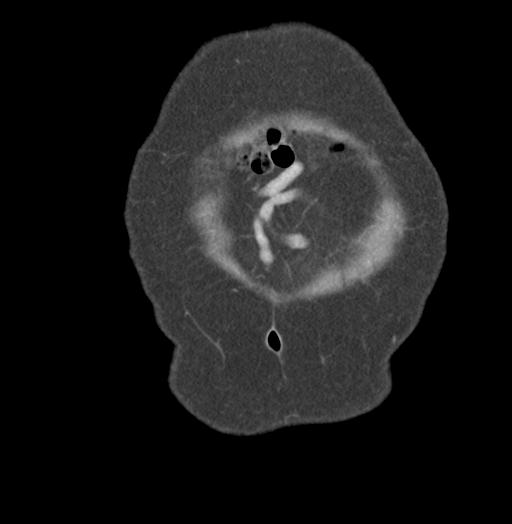 Adult ileal intussusception with secondary obstruction (Radiopaedia 30395-31051 Coronal C+ portal venous phase 6).jpg