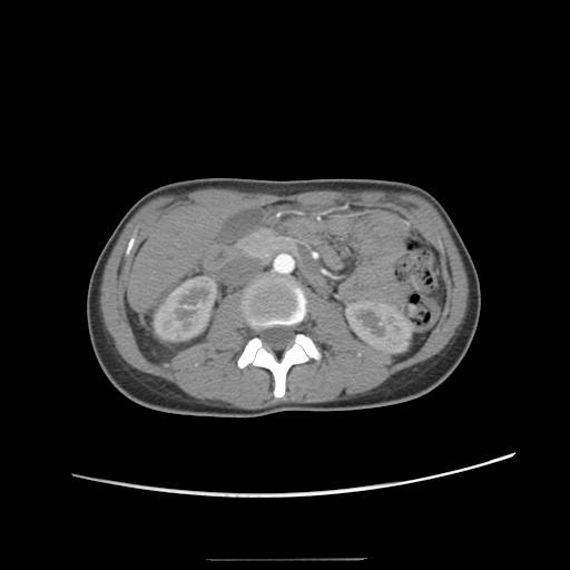 Adult polycystic kidney disease (Radiopaedia 48845-53876 Axial renal cortical phase 30).jpg