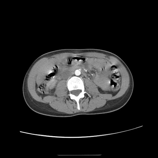 File:Adult polycystic kidney disease (Radiopaedia 48845-53876 Axial renal cortical phase 35).jpg