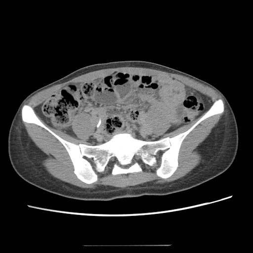 File:Adult polycystic kidney disease (Radiopaedia 48845-53876 Axial renal excretory phase 68).jpg