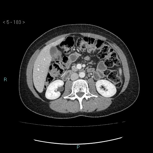 Adult transient intestinal intussusception (Radiopaedia 34853-36310 Axial C+ portal venous phase 30).jpg