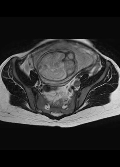 File:Aggressive angiomyxoma of the pelvis and perineum (Radiopaedia 59162-66479 Axial T2 19).jpg