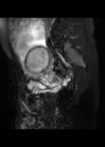 File:Aggressive angiomyxoma of the pelvis and perineum (Radiopaedia 59162-66479 Sagittal T2 fat sat 19).jpg