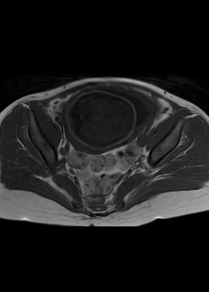 File:Aggressive angiomyxoma of the pelvis and perineum (Radiopaedia 59162-66479 T1 17).jpg