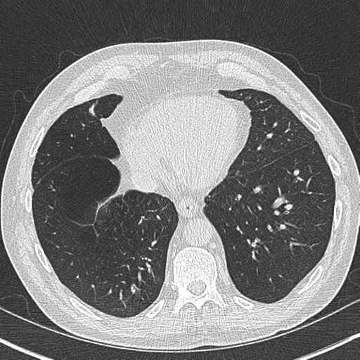 Allergic bronchopulmonary aspergillosis (Radiopaedia 44760-48571 Axial lung window 49).png