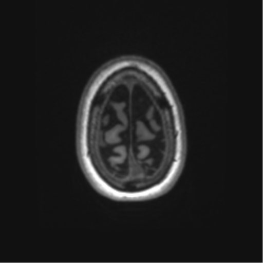 Alzheimer's disease (Radiopaedia 42658-45802 Axial T1 21).png